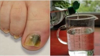 Água oxigenada para prevenir fungos das unhas