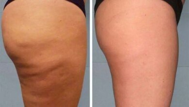 Como acabar com a celulite com creme caseiro