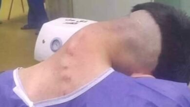 Homem sofre de rara síndrome da cabeça caída causada por vício