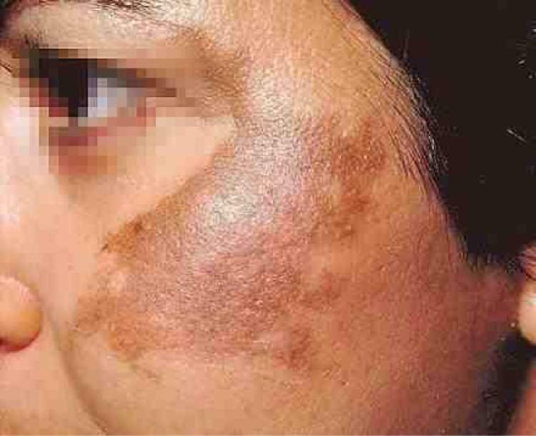 Livre-se das manchas pretas do seu rosto, agora com essa receita caseira