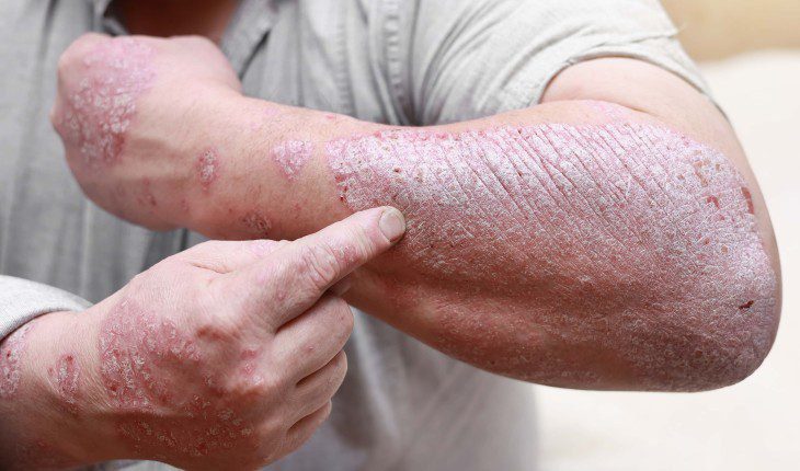 Psoríase: identificando sintomas e entendendo a doença