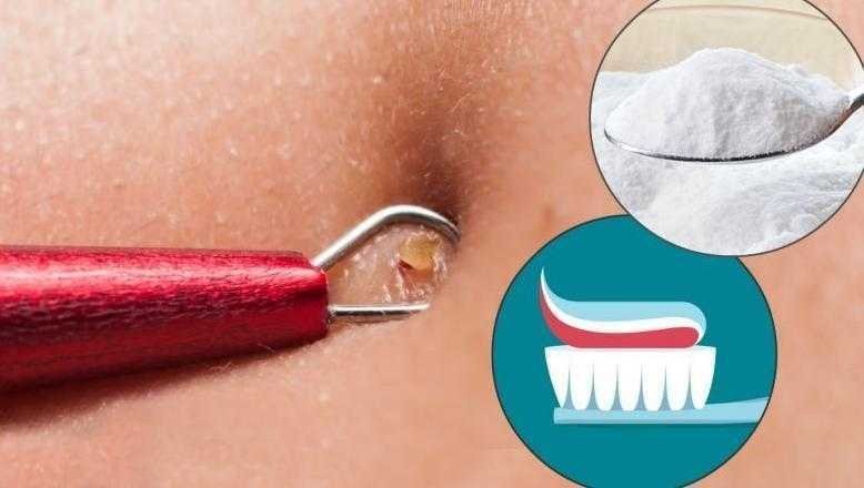Receita caseira para tirar cravos e espinhas em 2 minutos d