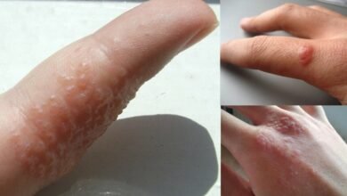 Se surgirem bolhas em suas mãos e pés, fique atento; pois pode ser sintomas de…