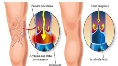 Aprenda ELIMINAR veias estouradas das pernas