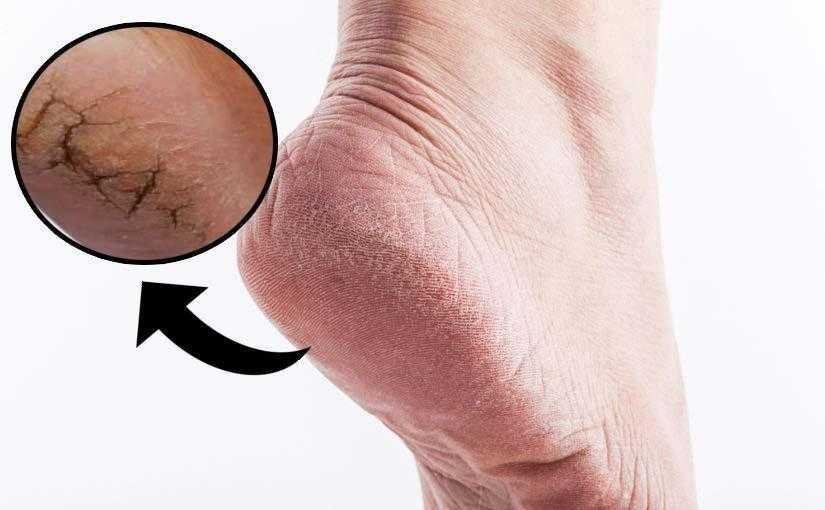 Creme caseiro para hidratar e afinar os pés