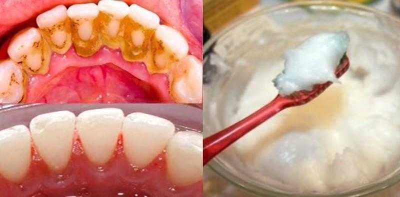 Elimine o tártaro e a placa bacteriana com essa receita caseira