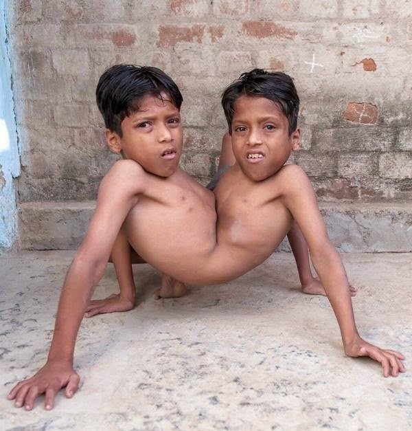 Gêmeos siameses de 12 anos Gêmeos siameses de 12 anos