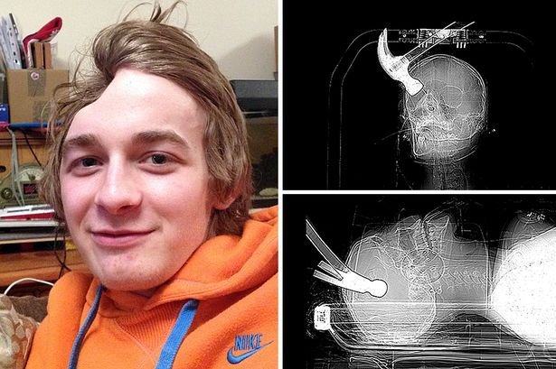 Jovem fica com cabeça deformada após receber marteladas de amigo Jovem fica com cabeça deformada após receber marteladas de amigo