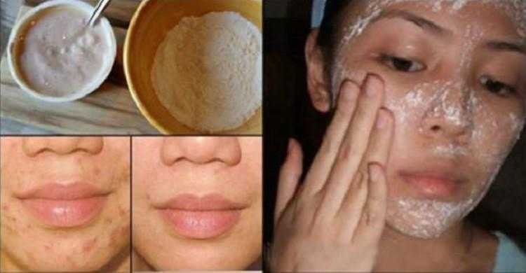 Máscara facial para tratar acne e cicatrizes a