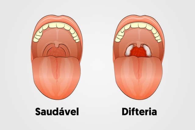 O Que é a Difteria?