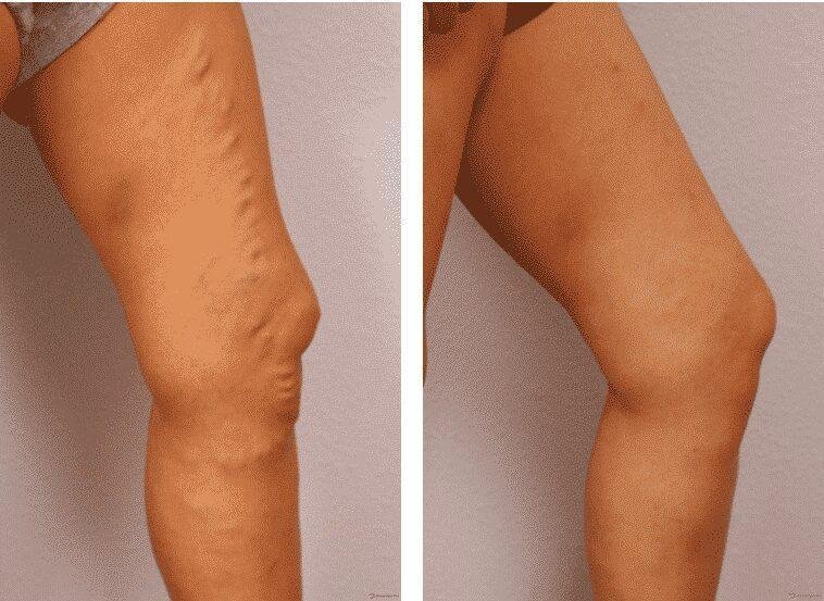 Receita de babosa para curar varizes e reativar circulação do sangue