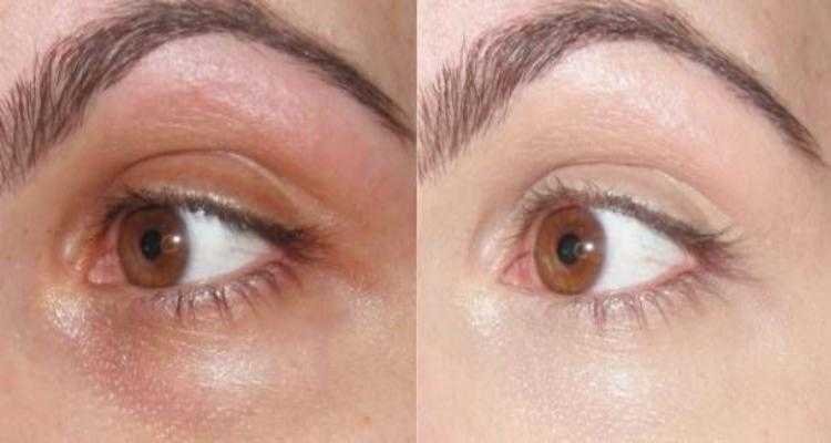 Receita de bicarbonato de sódio para manchas em volta dos olhos
