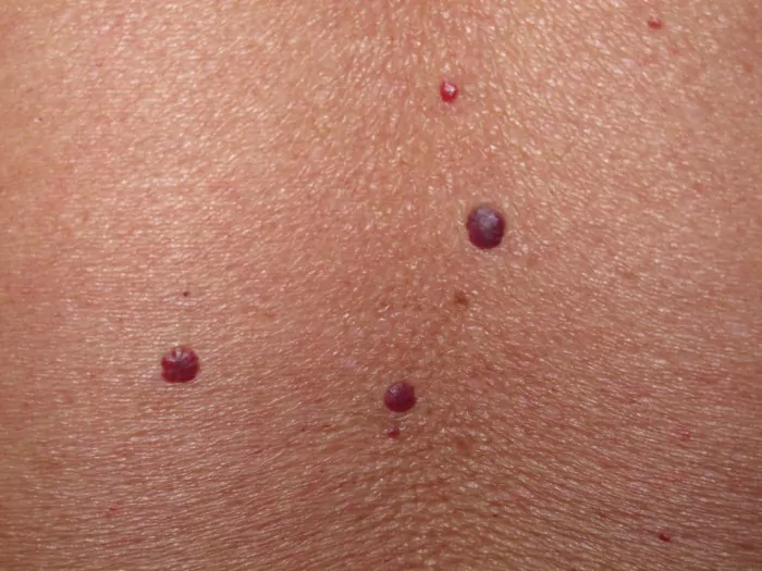 se você tem essas pintas no corpo, saiba por que esse é um problema que não pode ser ignorado sd