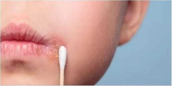 11 remedios caseiros para tratar herpes labial
