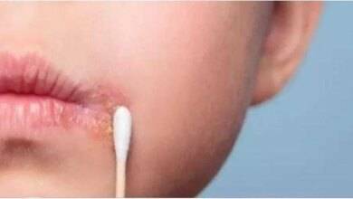 11 remedios caseiros para tratar herpes labial