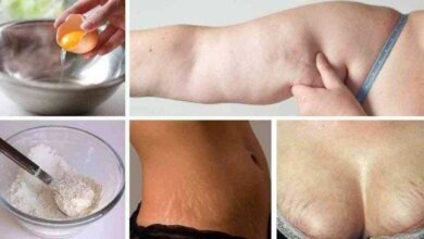 Os 3 melhores remédios para acabar com a celulite, flacidez e estrias