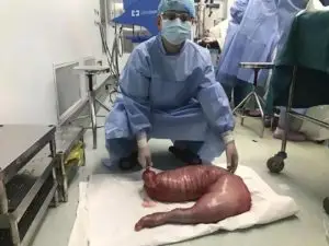 1751513745 379 cirurgiao removeu isso de um homem que estava constipado ha 1497368072 165 cirurgiao removeu isso de um homem que estava constipado ha anos