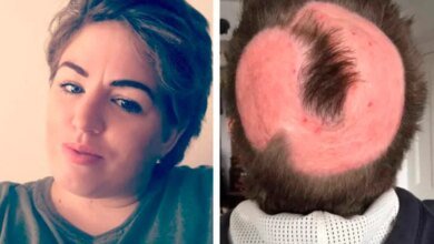 mulher pinta cabelo em casa e derrete o couro cabeludo