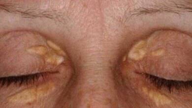 Se aparecer isto perto dos seus olhos, corra já para seu médico antes que seja tarde demais