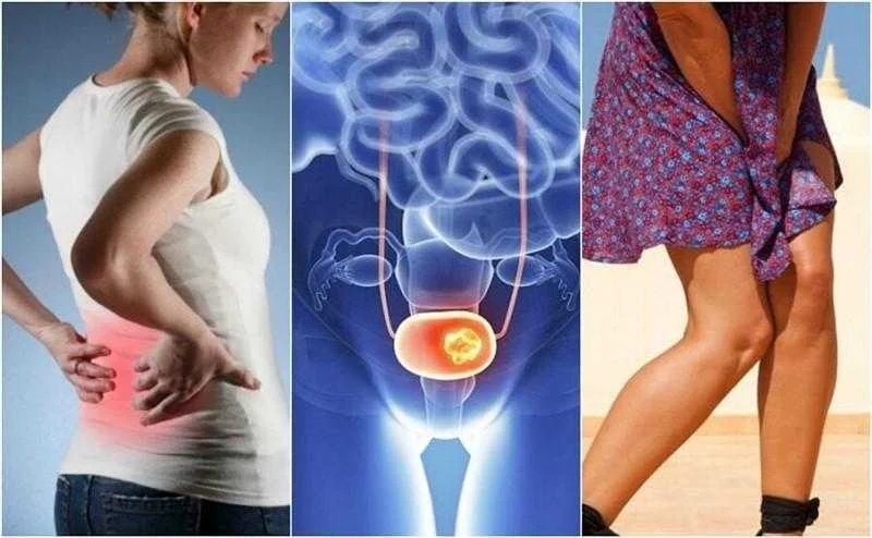 7 sinais de cancer de bexiga aos quais devemos ficar 7 sinais de câncer de bexiga aos quais devemos ficar atentos 1q