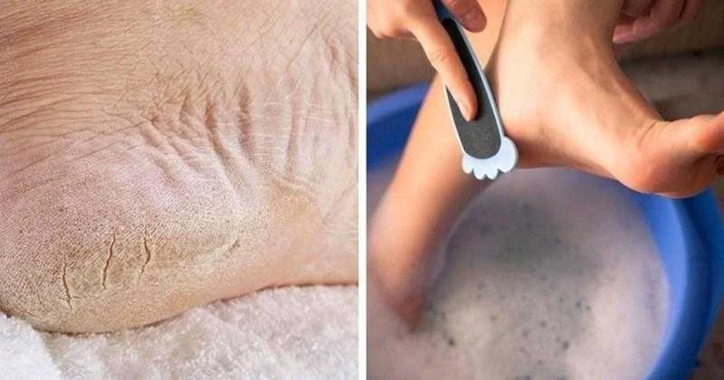 Remédios caseiros para pés secos e rachados fr