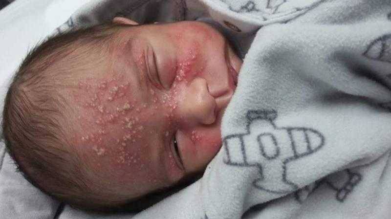 bebe de 17 dias contrai herpes apos beijo de visita Bebê de 17 dias contrai herpes após beijo de visita