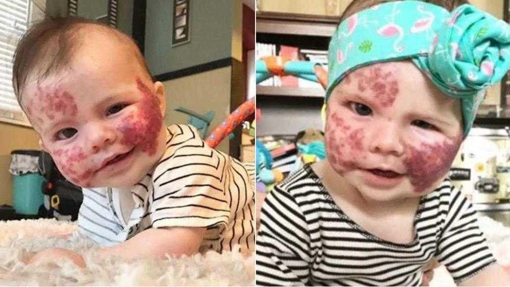 bebe passa por transformacao incrivel apos tratamento para manchas
