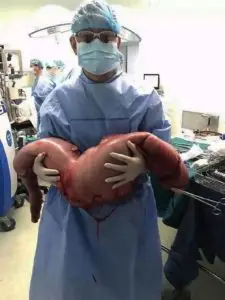 cirurgiao removeu isso de um homem que estava constipado ha 1497368072 783 cirurgiao removeu isso de um homem que estava constipado ha anos