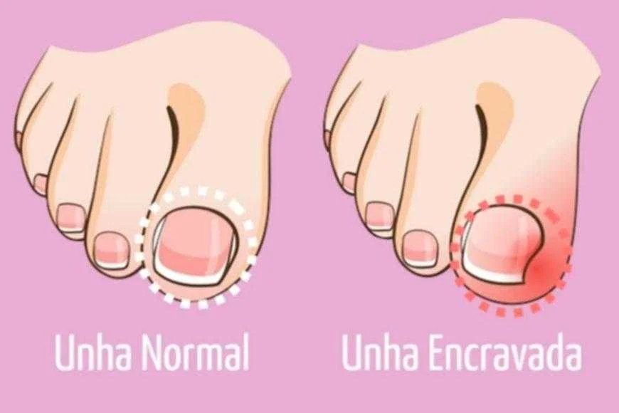 Como curar unhas encravadas