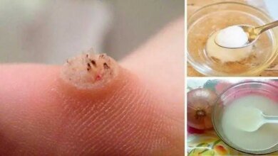 Como eliminar verrugas usando apenas 1 ingrediente
