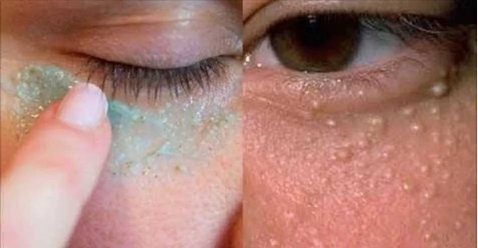ELIMINE RAPIDAMENTE AS BOLINHAS AO REDOR DOS OLHOS ELIMINE RAPIDAMENTE AS BOLINHAS AO REDOR DOS OLHOS