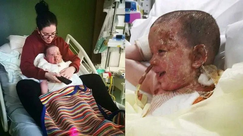 Menino deu exemplo de superação após queimadura