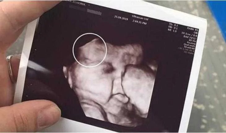 Mae fica assustada ao ver ultrassom da filha imagem mostrou
