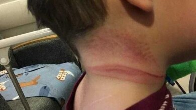 Mãe posta foto e faz alerta aos pais após filho quase se enforcar em acidente doméstico