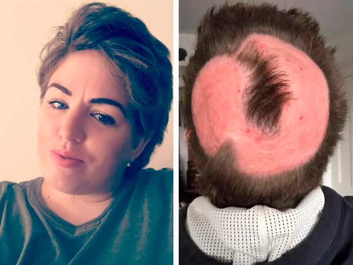 mulher pinta cabelo em casa e derrete o couro cabeludo