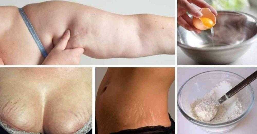 Os 3 melhores remédios para acabar com a celulite, flacidez e estrias