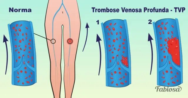 venous_thrombosis_01_800x418